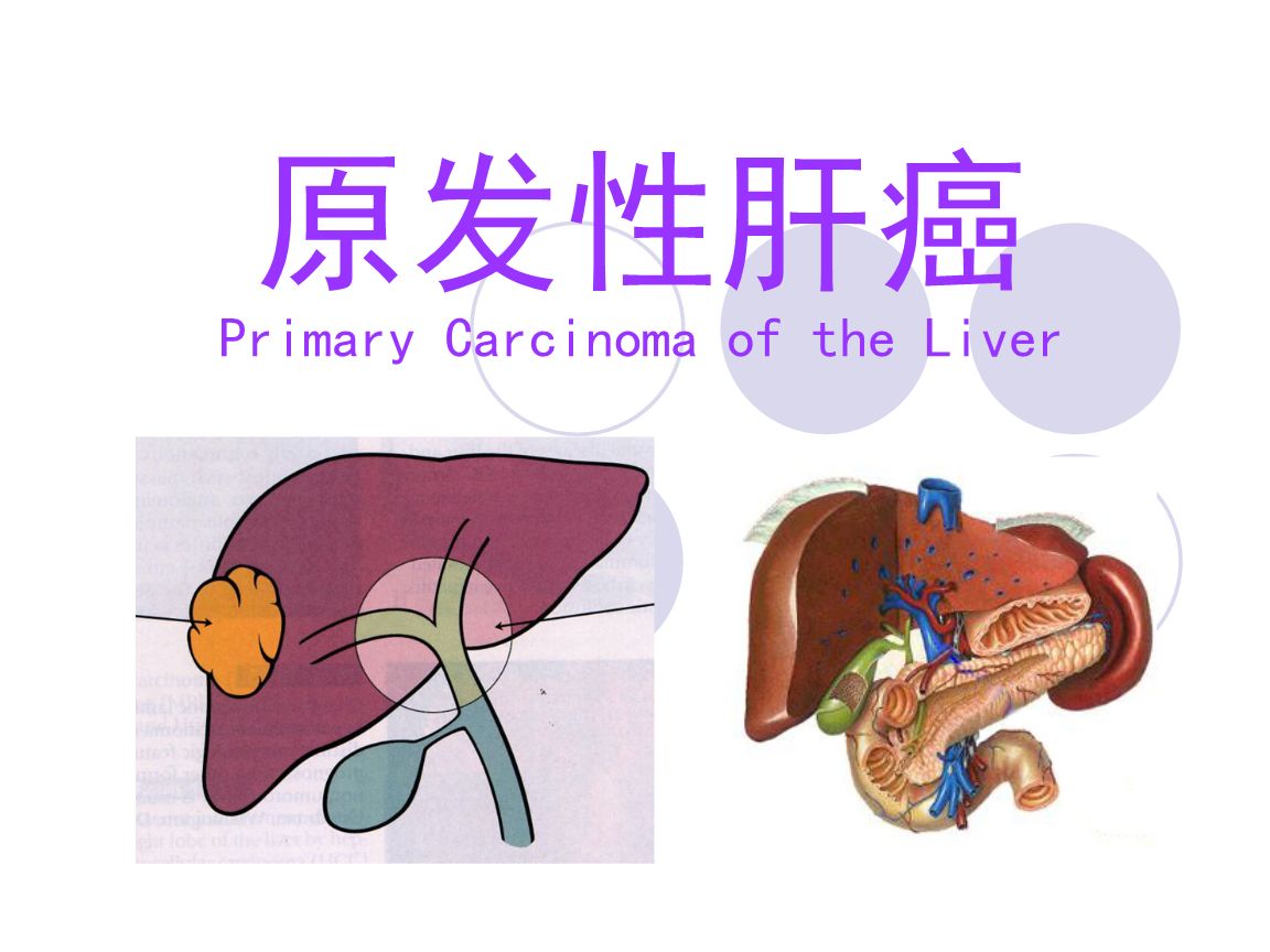 原發(fā)性肝癌