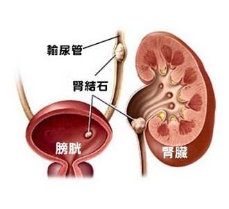 泌尿系結(jié)石