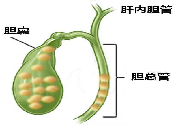 膽管結石