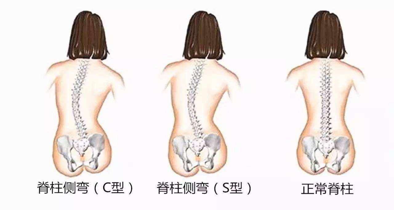 脊柱側(cè)彎