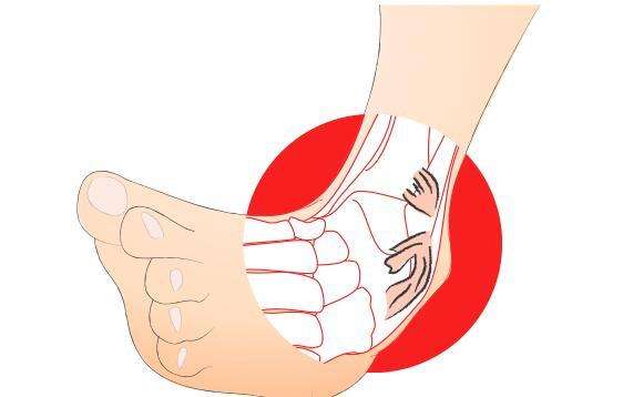 關(guān)節(jié)損傷