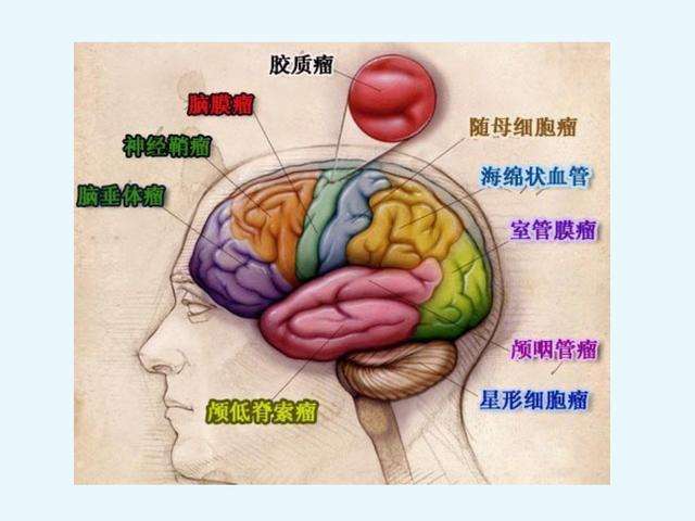 膠質(zhì)瘤