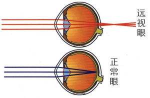 遠(yuǎn)視眼