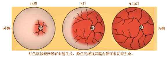 早產(chǎn)兒視網(wǎng)膜病變
