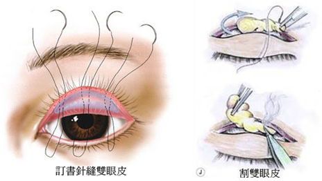 雙眼皮手術