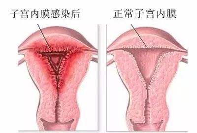 子宮內膜息肉